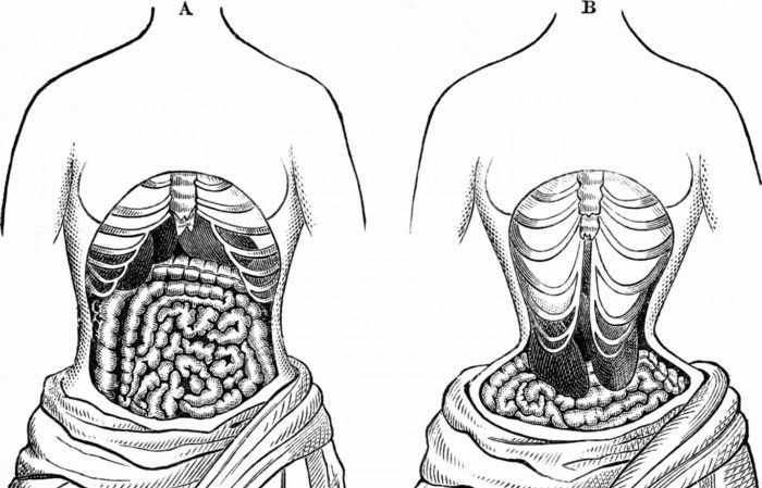 A shows the natural position of the organs, B shows the deformed internal organ layout after wearing a restrictive compression garment